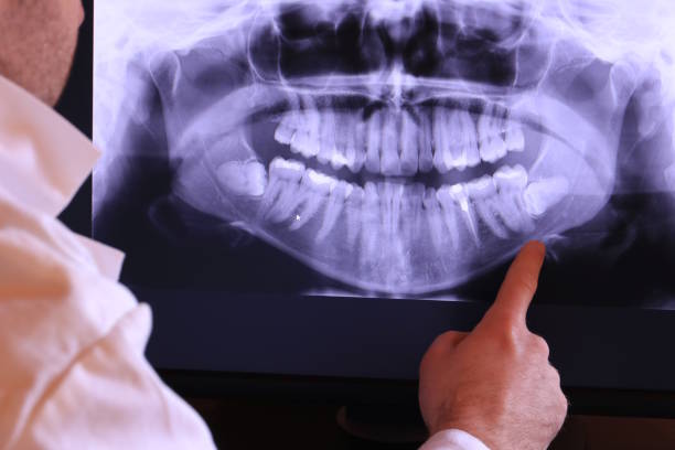 Best Emergency Wisdom Tooth Extraction in Kingwood, WV